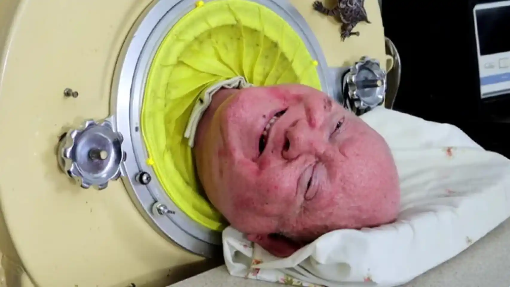 Paul Alexander el hombre de Texas, vivió más de 70 años conectado a un pulmón de acero, tras contraer poliomielitis cuando era un niño, en 1952, y falleció a los 78 años tras contagiarse de Covid-19.