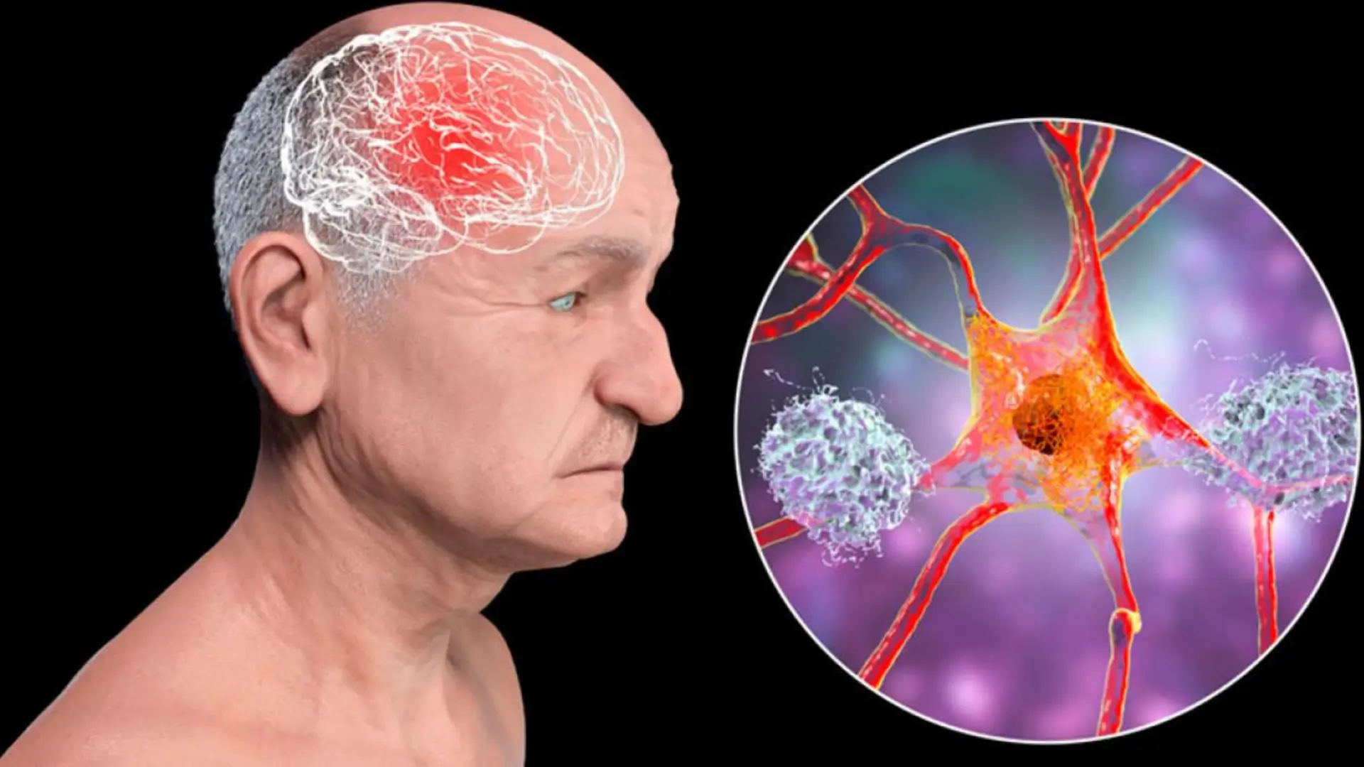 Este reciente descubrimiento podría transformar la manera en que se diagnostica y se trata el Alzheimer. Te contamos todos los detalles.