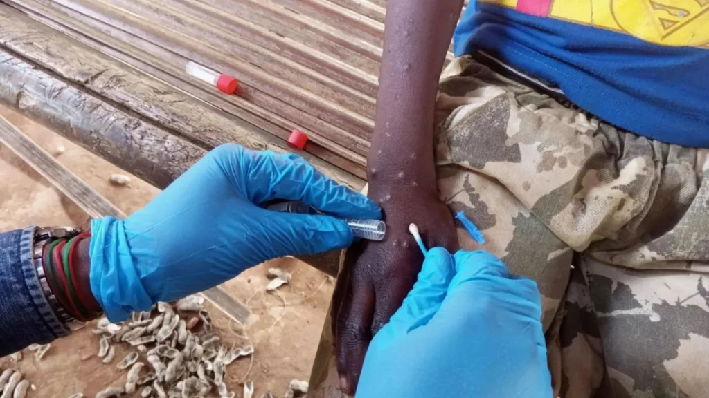 OMS declara “emergencia de salud pública” el brote de viruela símica en Congo