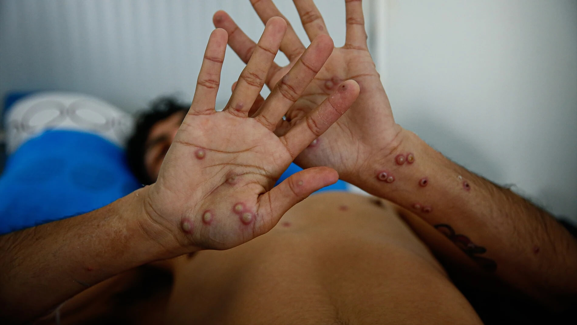 por confirmar caso de viruela del mono se ha sometido a una evaluación clínica el caso de una familia proveniente del departamento de Lempira