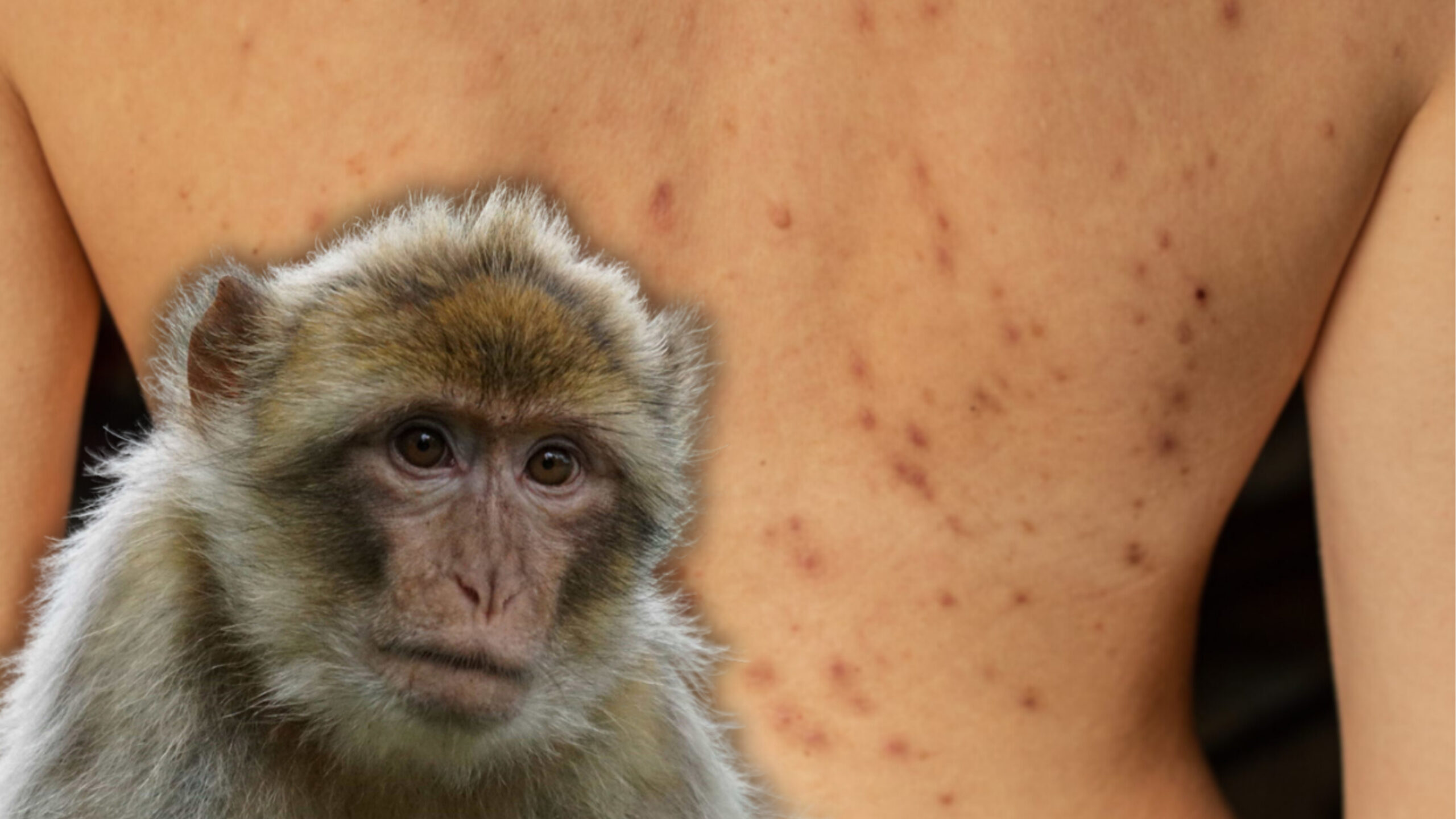 Confirman nuevos casos de viruela del mono en Cortés